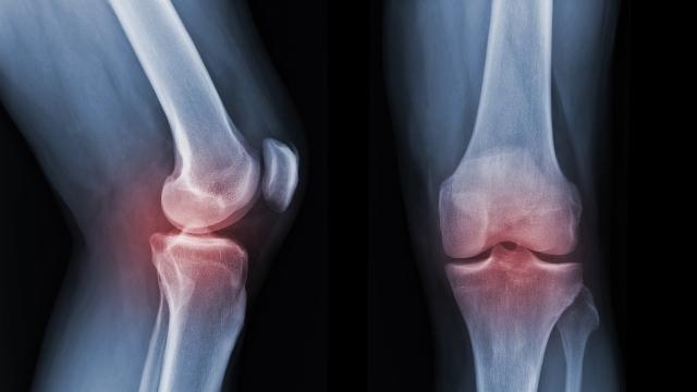 imaging for arthritis treatment